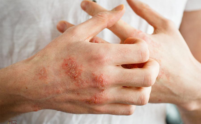 Bệnh chàm gây tổn thương theo từng mảng da
