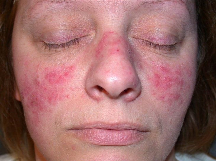 Dấu hiệu bệnh lupus ban đỏ