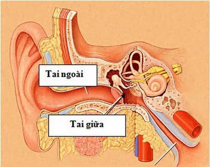 Điếc dẫn truyền do tổn thương tai ngoài và tai giữa