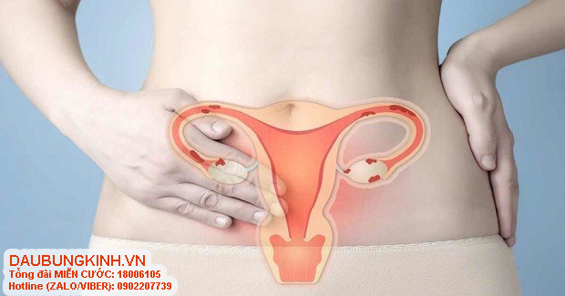 Khoảng 10% phụ nữ trên thế giới bị lạc nội mạc tử cung