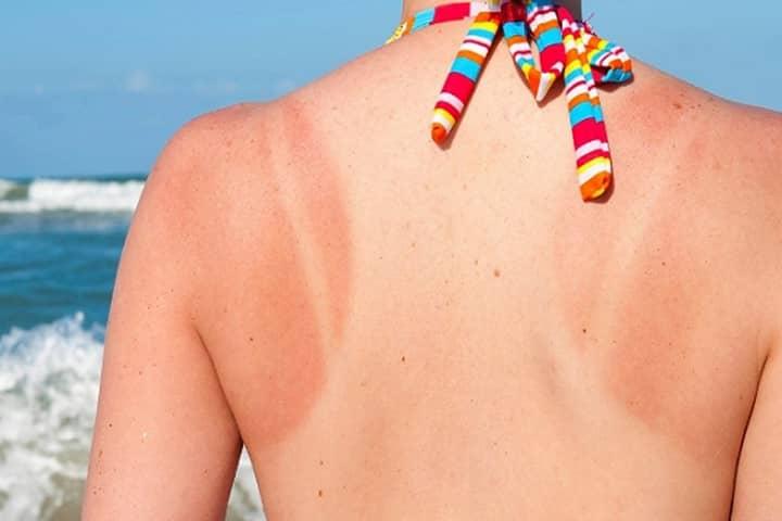 Bị cháy nắng có thể kích hoạt vẩy nến toàn thân bùng phát