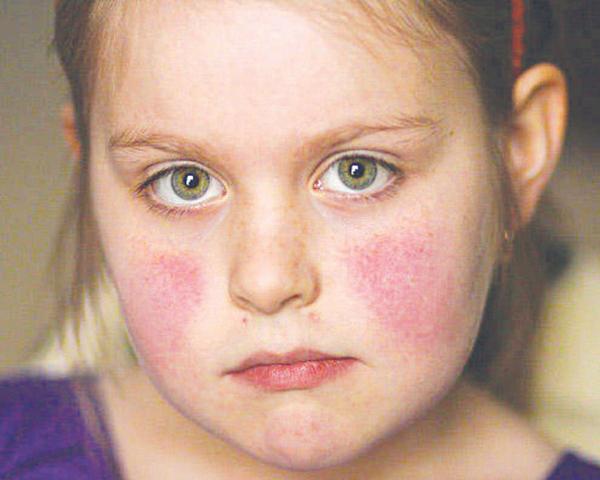 Trẻ em cũng có thể mắc lupus ban đỏ