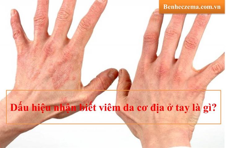 Những biểu hiện thường gặp của bệnh viêm da cơ địa ở tay là gì?