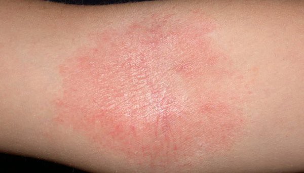 Bệnh chàm thường xuất hiện các mảng đỏ trên da