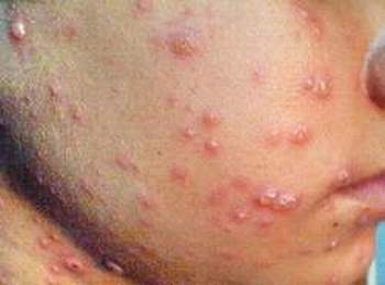 Bệnh eczema không đượkc điều trị kịp thời sẽ dẫn đến lichen hóa