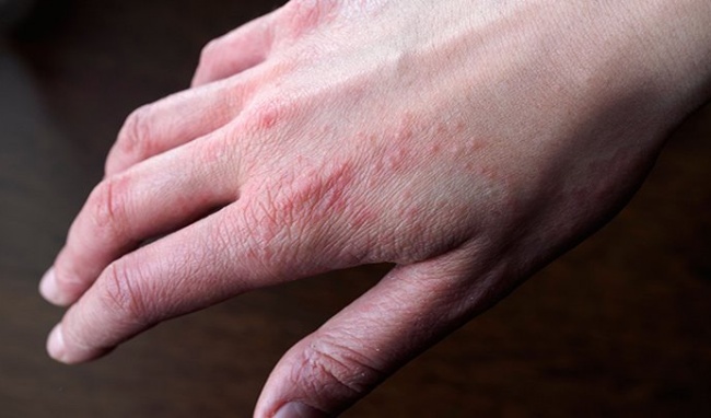 Bệnh eczema ở tay