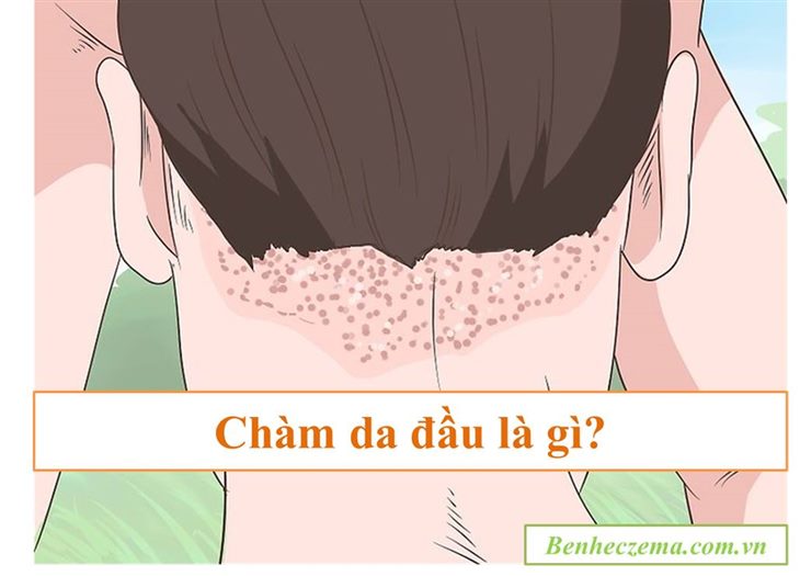 Bệnh chàm da đầu là gì?
