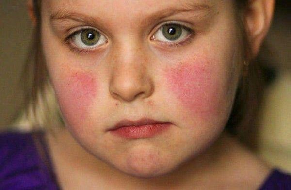 Dấu hiệu lupus ban đỏ ở trẻ em