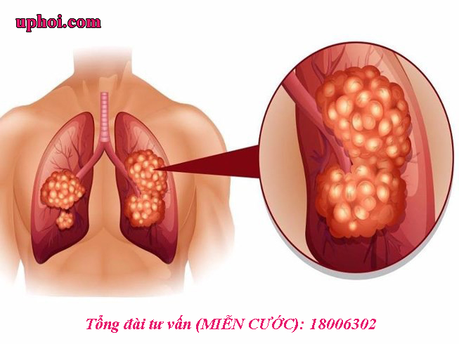 Một số bệnh phế quản phổi có thể gây u phổi