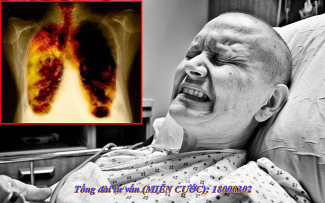 U phổi ác tính không phải là bệnh truyền nhiễm
