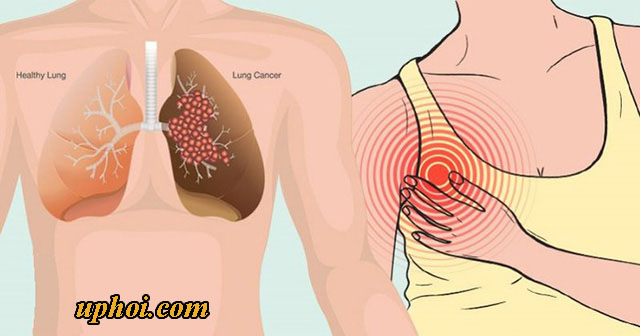 U phổi là bệnh lý phổ biến nguy hiểm đến tính mạng