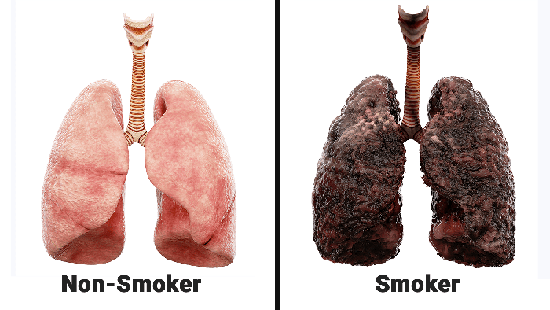 Ảnh hưởng nghiêm trọng của khói thuốc lá tới phổi