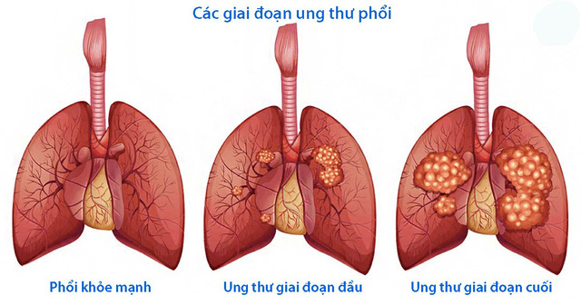 U phổi ác tính tiến triển qua nhiều giai đoạn