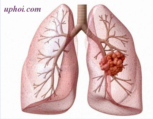 U phổi phát triển qua nhiều giai đoạn