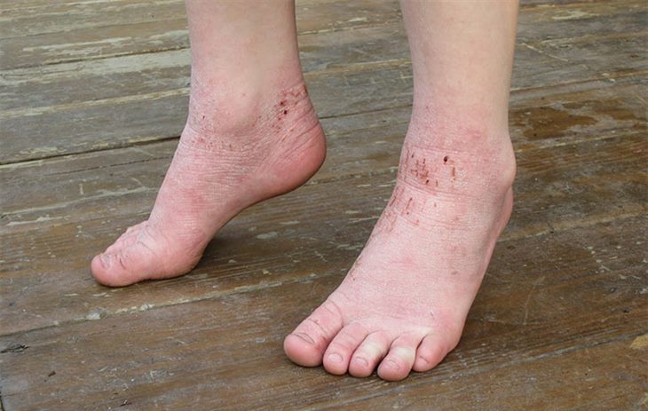 Hình ảnh về bệnh tổ đỉa ở chân