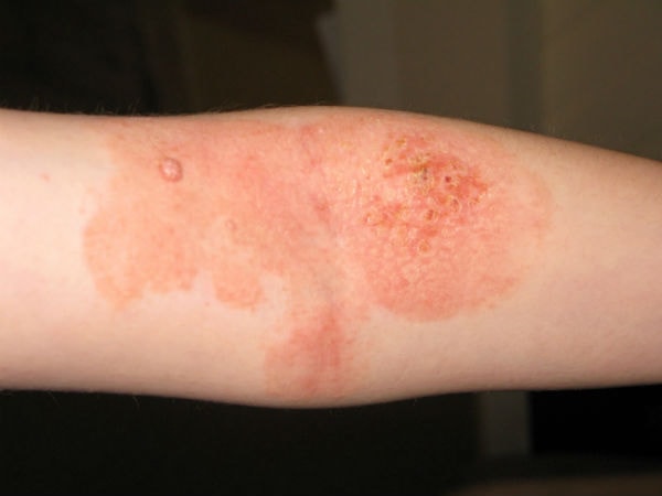 Bệnh viêm da tiếp xúc có triệu chứng là ngứa và đỏ rát