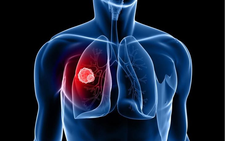 U phổi có 2 loại là lành tính và ác tính