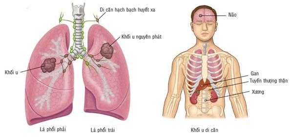 U phổi di căn có thể ảnh hưởng đến não, gan, tuyến thượng thận và xương