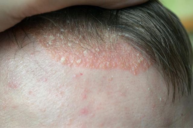 Dấu hiệu bệnh vẩy nến da đầu