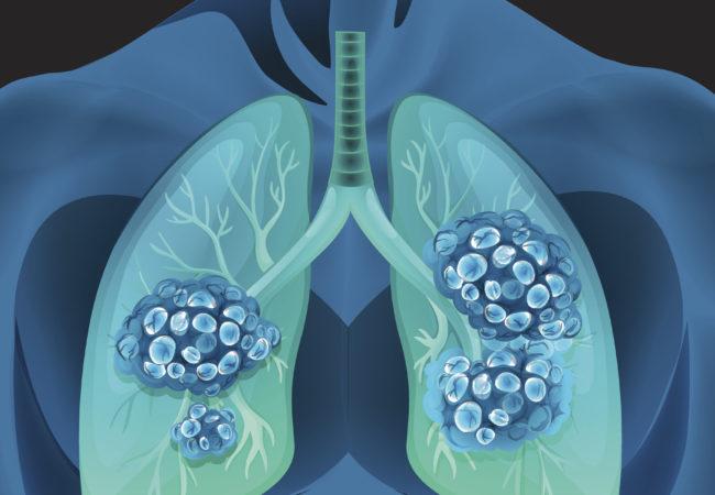 U phổi có thể được điều trị bằng cách kết hợp nhiều phương pháp
