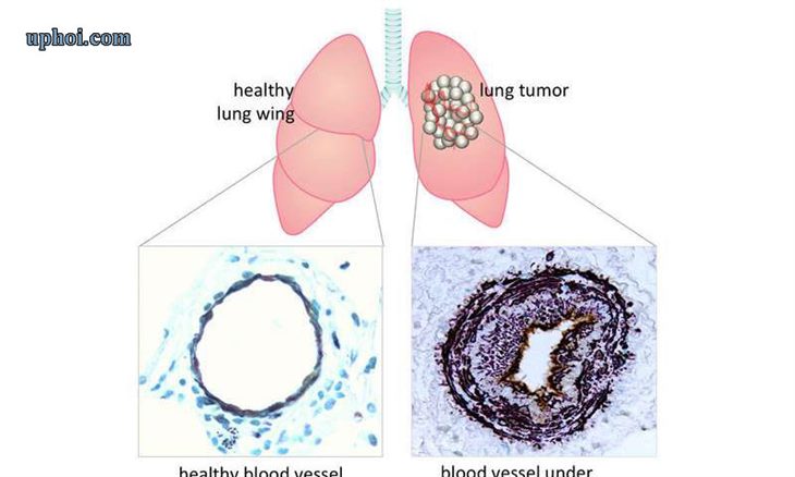 U phổi lành tính là gì?