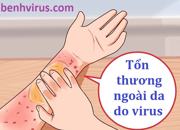   Hình ảnh các tổn thương ngoài da do virus tấn công