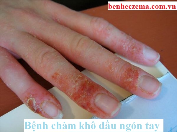 Bệnh chàm khô đầu ngón tay là gì?