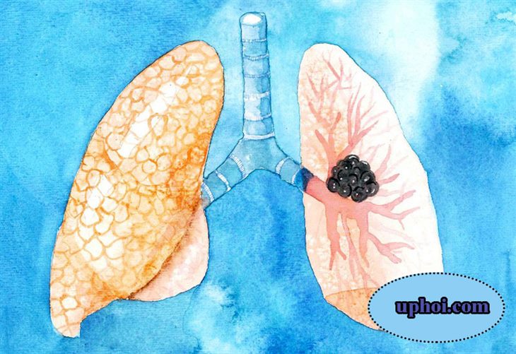 U phổi là bệnh như thế nào?