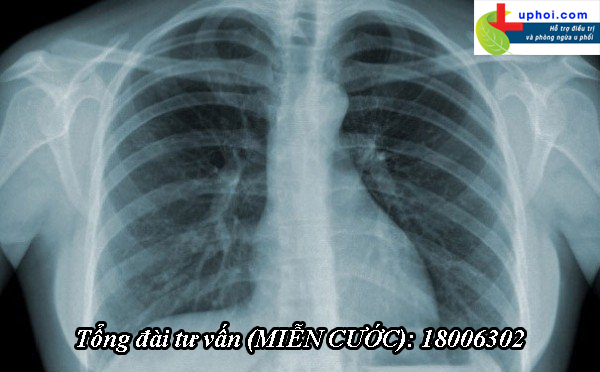 Chụp CT chẩn đoán u màng phổi