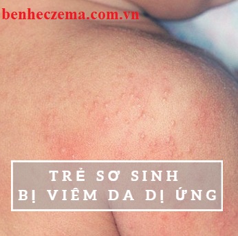 Làn da của trẻ sơ sinh rất yếu và nhạy cảm nên dễ mắc bệnh viêm da dị ứng