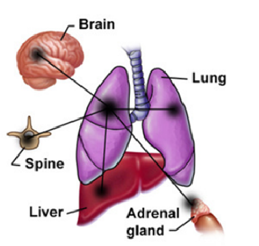 U phổi di căn đến nhiều vị trí khác nhau