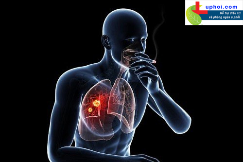 Khói thuốc lá là một trong những nguyên nhân phổ biến gây u phổi
