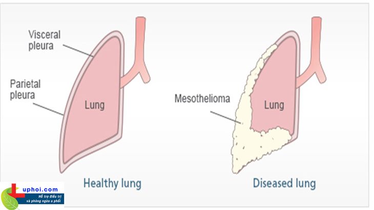 U ác tính màng phổi là gì?