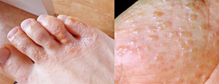 Bệnh tổ đỉa bàn chân thường có dấu hiệu đặc trưng nhận biết là các mụn nước