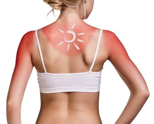Da bị cháy nắng có thể kích hoạt bùng phát lupus ban đỏ dạng đĩa