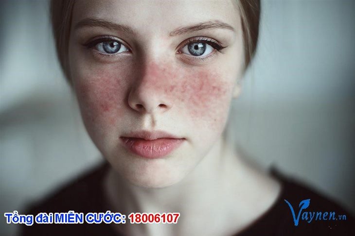 Triệu chứng lupus ban đỏ đặc trưng