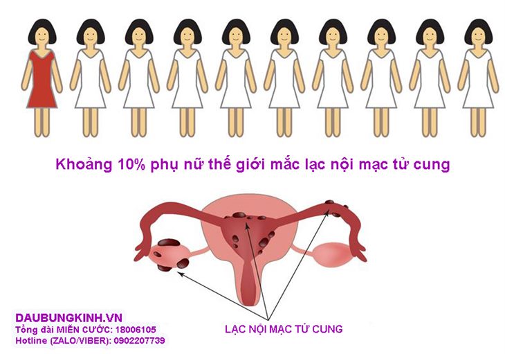 Khoảng 10% phụ nữ thế giới mắc lạc nội mạc tử cung