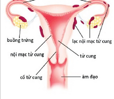 Lạc nội mạc tử cung là nguyên nhân gây đau bụng kinh thứ phát phổ biến nhất