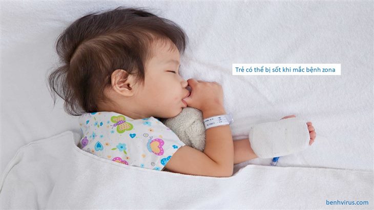 Trẻ thường bị sốt khi mắc bệnh zona