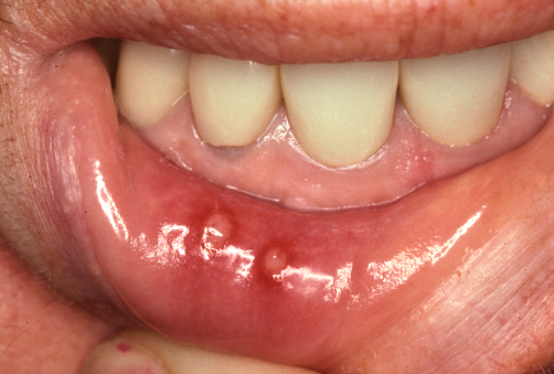   Loét miệng – Tình trạng phổ biến nhiều người mắc phải