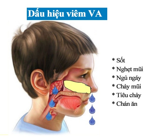 Một số dấu hiệu viêm VA ở trẻ