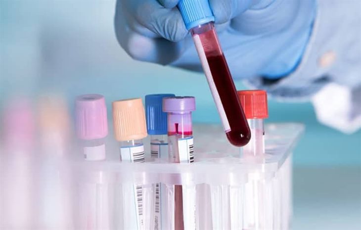 Xét nghiệm máu nhằm chẩn đoán chính xác mức độ bệnh lupus ban đỏ 
