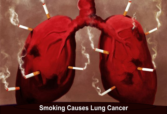 Thuốc lá là nguyên nhân phổ biến gây ung thư phổi nguyên phát
