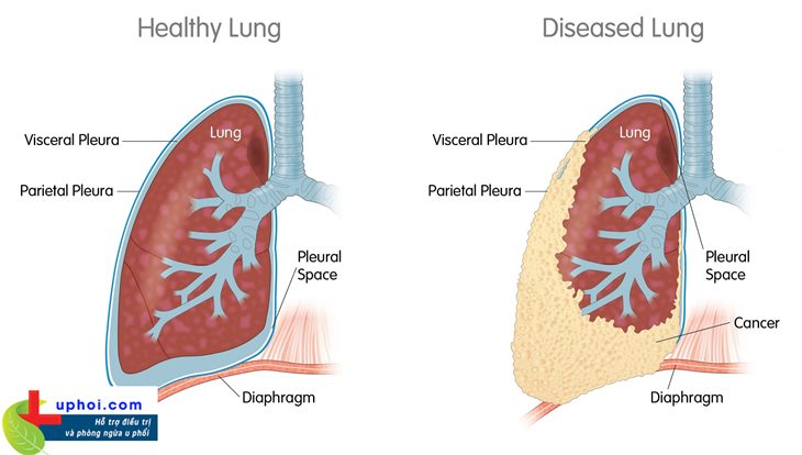 Ung thư màng phổi là bệnh lý nguy hiểm