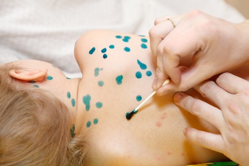 Bệnh thuỷ đậu thường gặp ở trẻ chưa tiêm vắc-xin