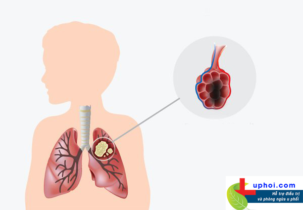 Ung thư phổi là bệnh lý nguy hiểm cần đề phòng