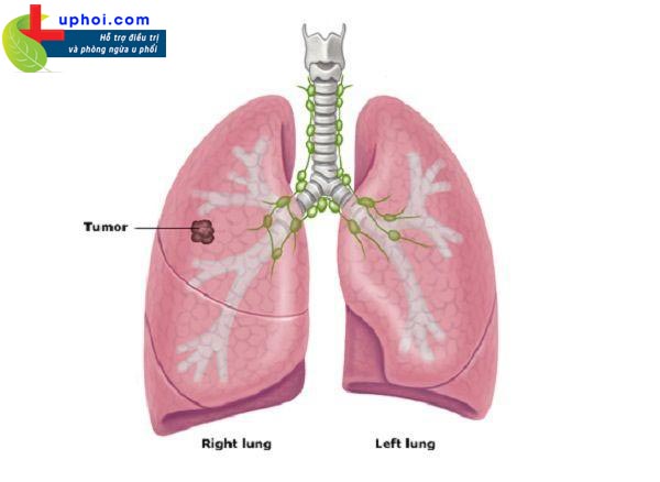Ung thư phổi giai đoạn 2