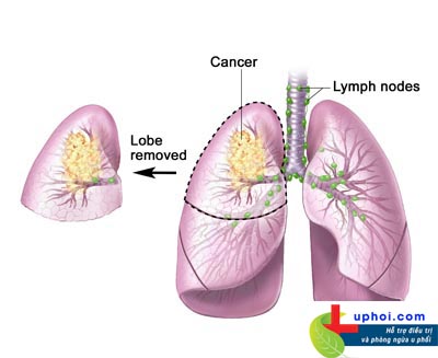 Ung thư phổi là bệnh gì?
