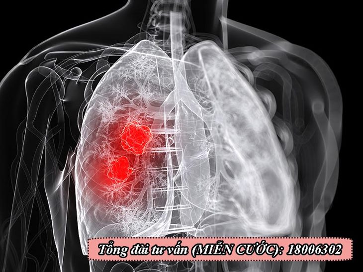 Ung thư phổi tiến triển qua nhiều giai đoạn