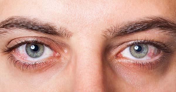 Vảy nến ở mí mắt có thể dẫn tới bệnh viêm màng bồ đào